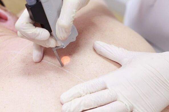 Priljubljena metoda za odstranjevanje papiloma z laserjem