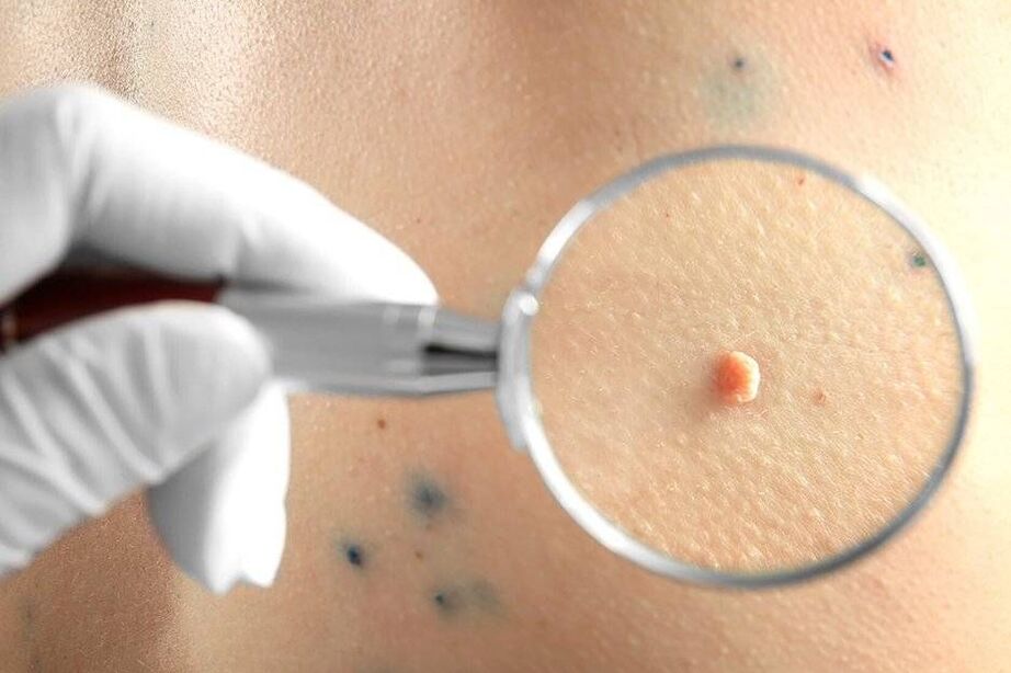 Zdravljenje HPV