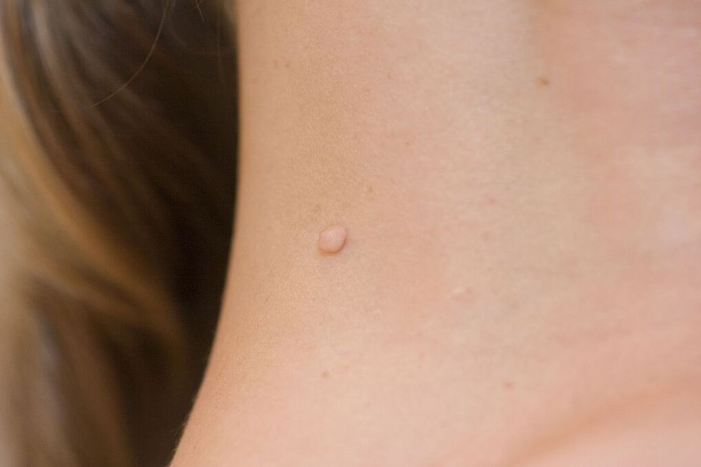 simptomi HPV