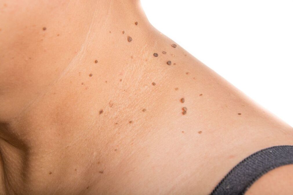 zapleti HPV