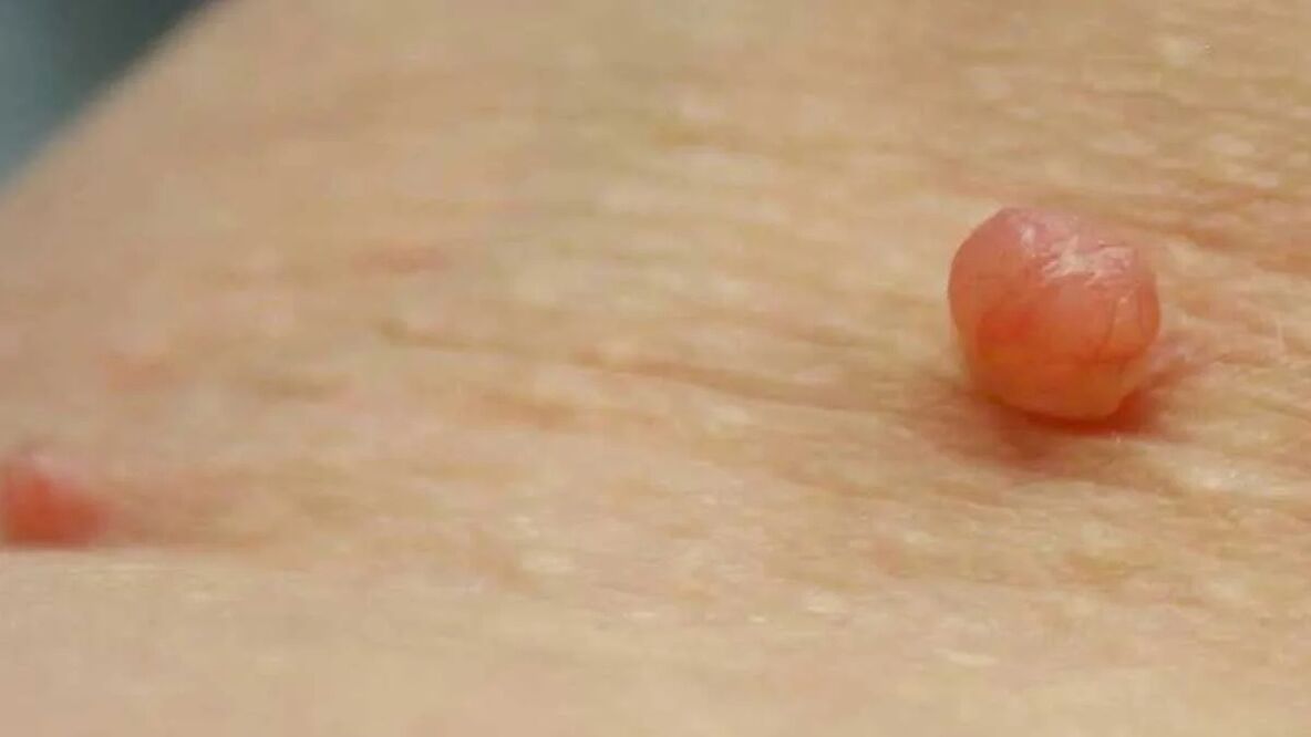 odstranitev papiloma doma